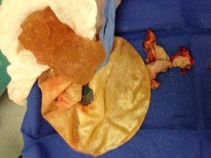 Ruptured Silicone Breast Implants