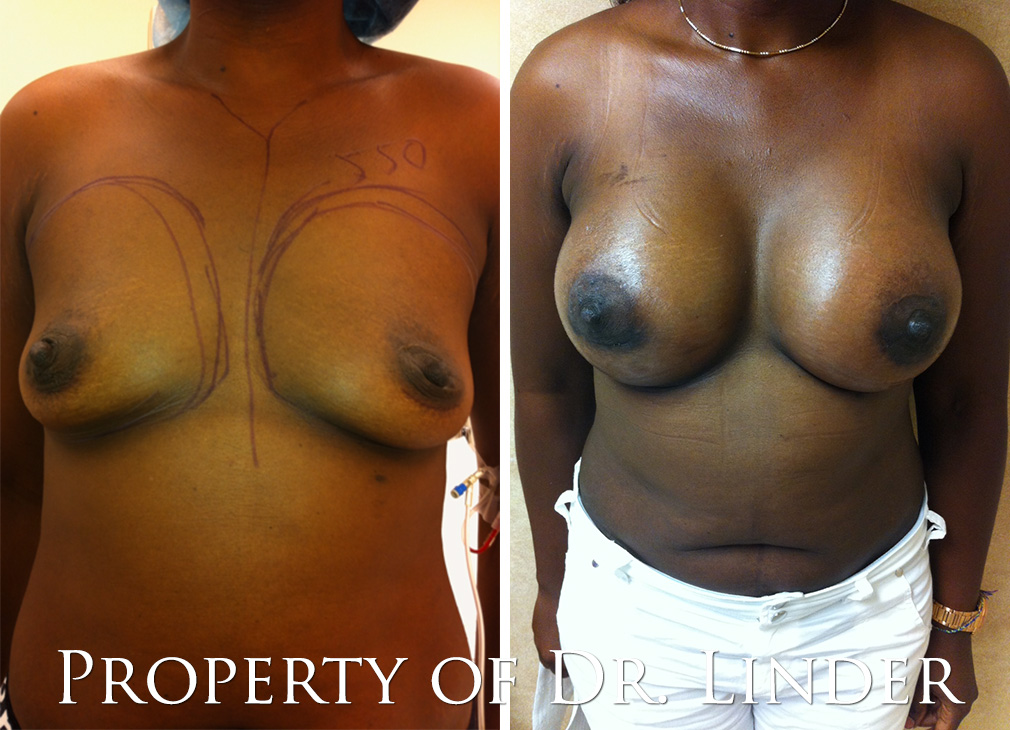 before and after breast enhancement surgery