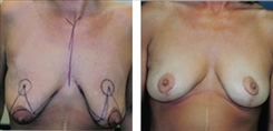 Breast Lift Before and After 