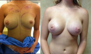 Breast Asymmetry Before and After photo