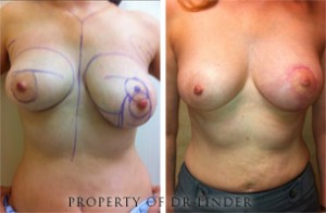 Breast Asymmetry Before and After