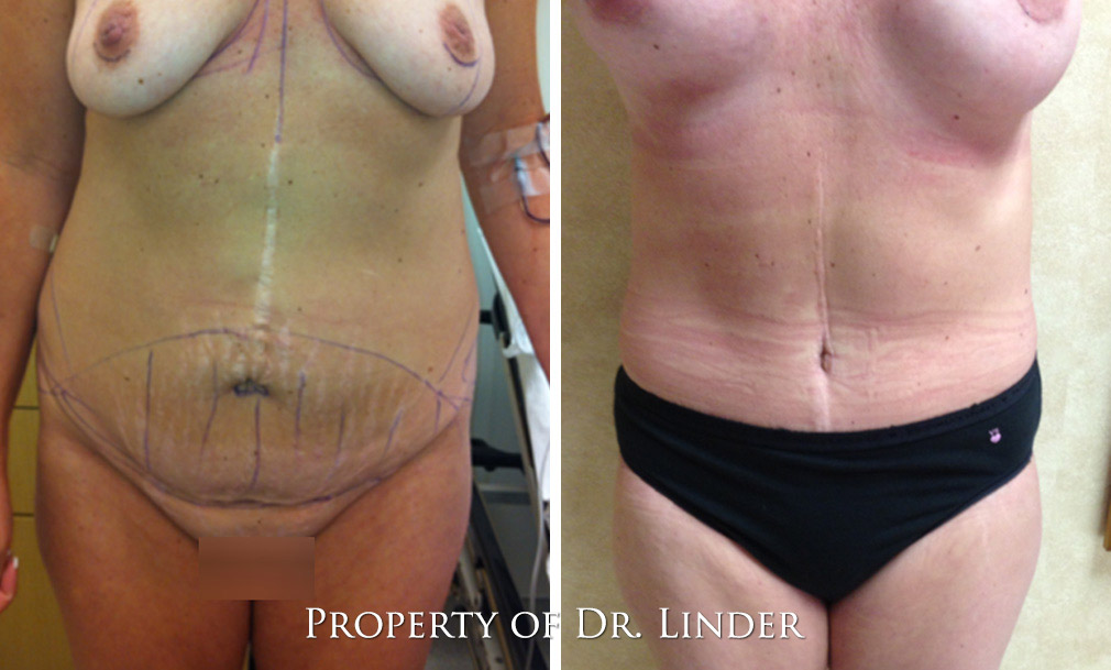 Tummy Tuck Before and After Photos