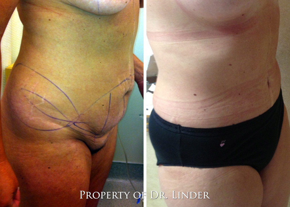 Tummy Tuck Before and After Photos Side View