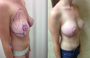 Before and After Breast Augmentation