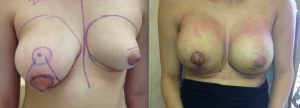 Before and After Breast Augmentation