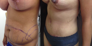 BEVERLY HILLS ABDOMINOPLASTY