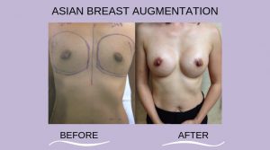 Breast Augmentation Before and After 