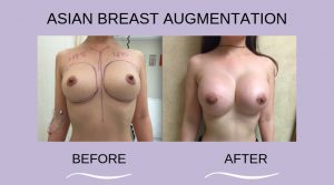 Before and After Breast Augmentation Procedure 