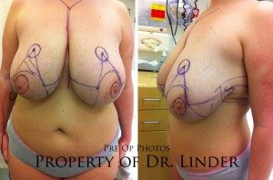 Breast Reduction Mark Ups