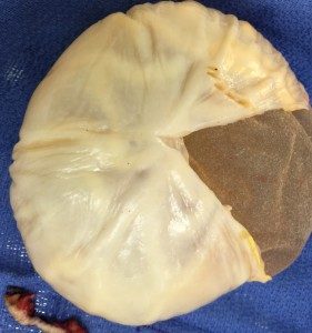 Ruptured Silicone Implant 