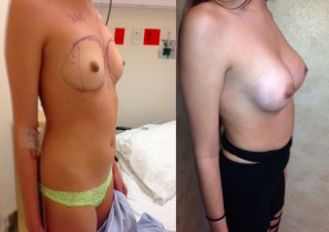 Breast Augmentation Before and After Photos