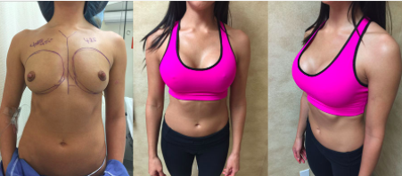 Breast Augmentation Results Wearing SEXY SHAPEWEAR™ Sports Bra