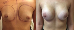 Breast Augmentation Before & After