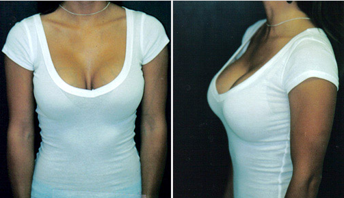 7 Advantages of High Profile Breast Implants Dr. Stuart A. Linder.