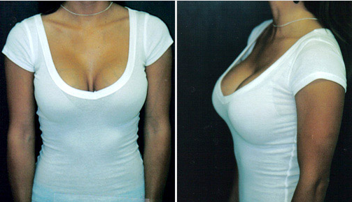 What's the Best Type of Breast Implants & Other Top Breast