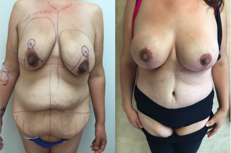 Before and after image showing the results of a body lift 