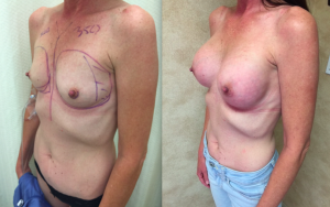 Before and After, Breast Augmentation On Slim Build