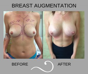 Before and After Photo of Woman Having Breast Augmentation