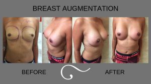 Before and After Photo of Woman Having Breast Augmentation 