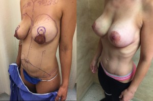 breast augmentation, lift and tummy tuck