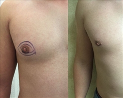 Male Breast Reduction  