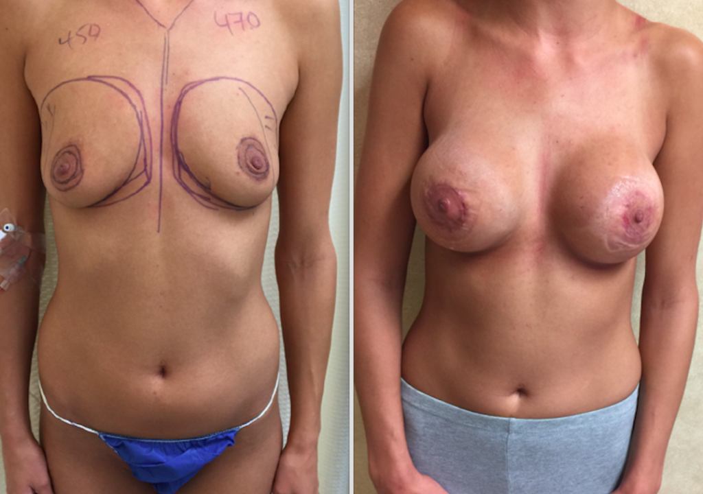 Breast explant with lift dallas