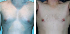 Gynecomastia Patient Before & After Photo 1