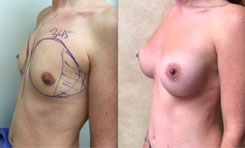 Breast Augmentation Patient Before & After Photo 1