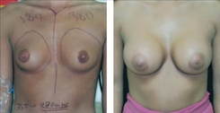 Breast Augmentation Patient Before & After Photo 1