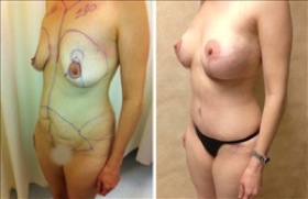 Woman Having Undergone Mommy Makeover Surgery 