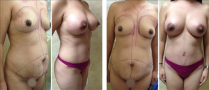 Before and After Tummy Tuck Surgery 
