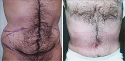 Tummy Tuck for Men Patient Before & After Photo 1