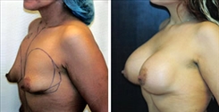 Tubular Breast Deformity Patient Before & After Photo 1