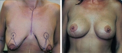 Body Procedures Patient Before & After Photo 1