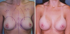 Pectus Carinatum Breast Patient Before & After Photo 1