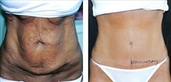 Combination Procedures & Body Sculpting Patient Before & After Photo 1