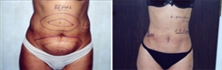 Liposuction Patient Before & After Photo 1