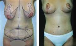 Before and after lateral view Panniculectomy - Sadove Cosmetic Surgery