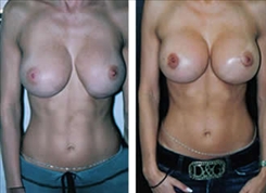 Breast Implant Revision Patient Before & After Photo 1