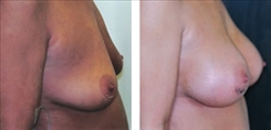 Breast Lift Patient Before & After Photo 1