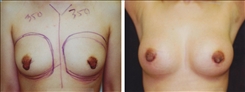 Nipple Reduction Patient Before & After Photo 1