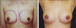 Breast Procedures Patient Before & After Photo 1