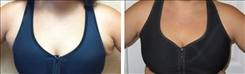 Bra Buldge Patient Before & After Photo 1