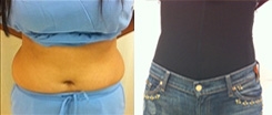 Muffin Top Patient Before & After Photo 1