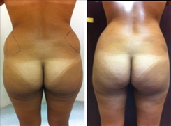 Body Procedures Patient Before & After Photo 1