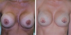 Pectus Excavatum Breast Patient Before & After Photo 1