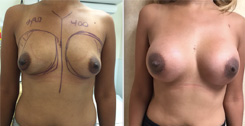 African American Breast Implants Patient Before & After Photo 1