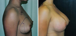 Breast Asymmetry