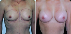 Breast Augmentation