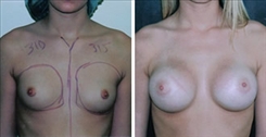 Breast Procedures Patient Before & After Photo 1